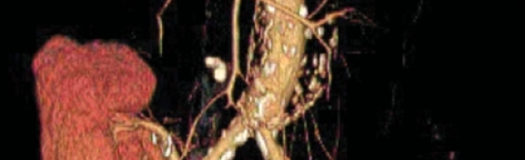 Angioplastie artère rénale