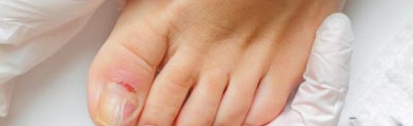 Pathologies ungueale pied infecté