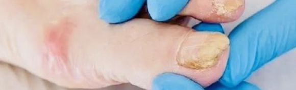 Pathologies unguéales