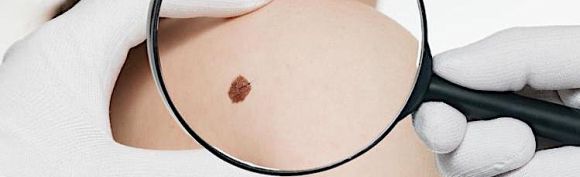 PHOTO formation Cancer-cutane-diagnostic