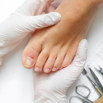 Pathologies ungueale pied infecté
